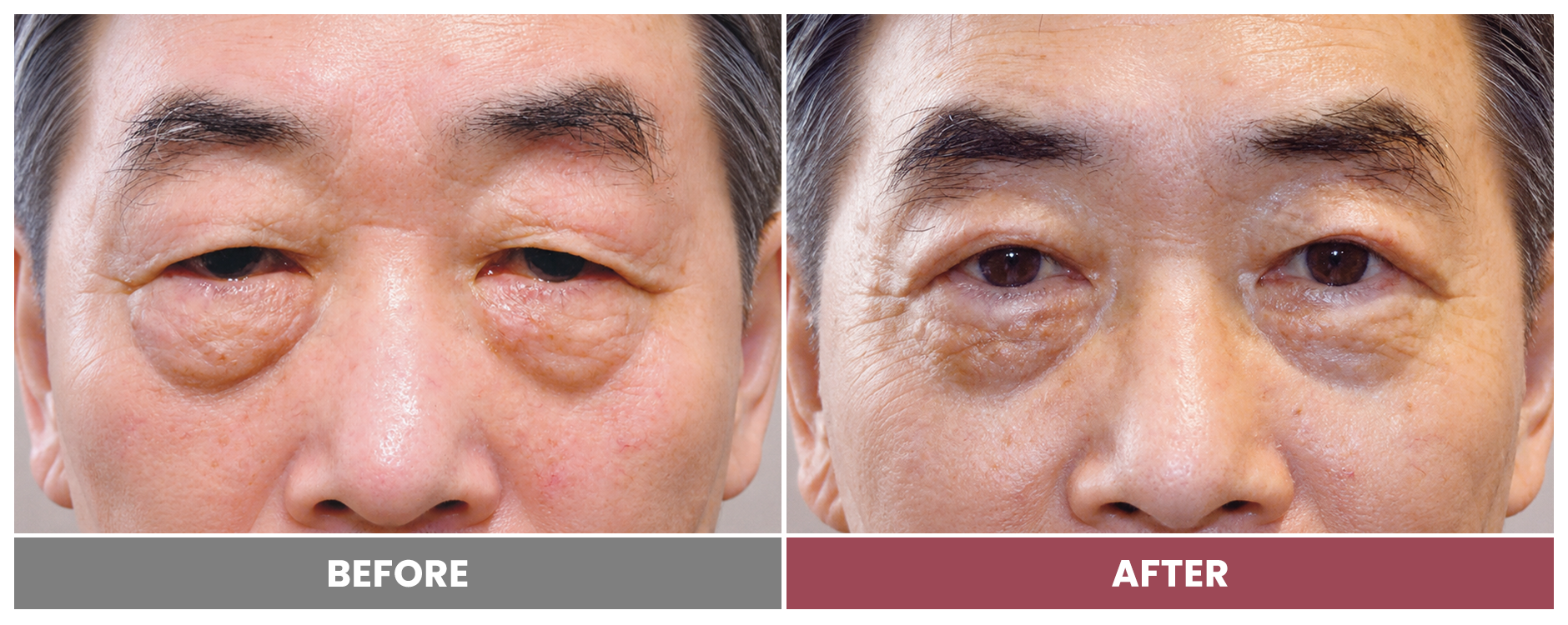 Upper Blepharoplasty - Case 32
